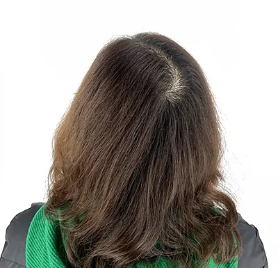 두피문신 교육 및 전문가 양성 | 로라도트 SMP 아카데미 - 여성 SMP - 정수리 두피문신