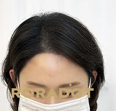 두피문신 교육 및 전문가 양성 | 로라도트 SMP 아카데미 - 여성 SMP - 흉터커버 두피문신