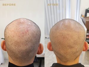 로라도트 남성 SMP - 삭발 before & after