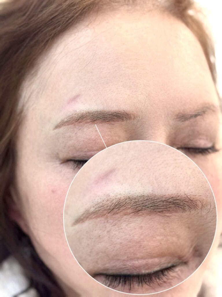 60대 붉은눈썹 잔흔