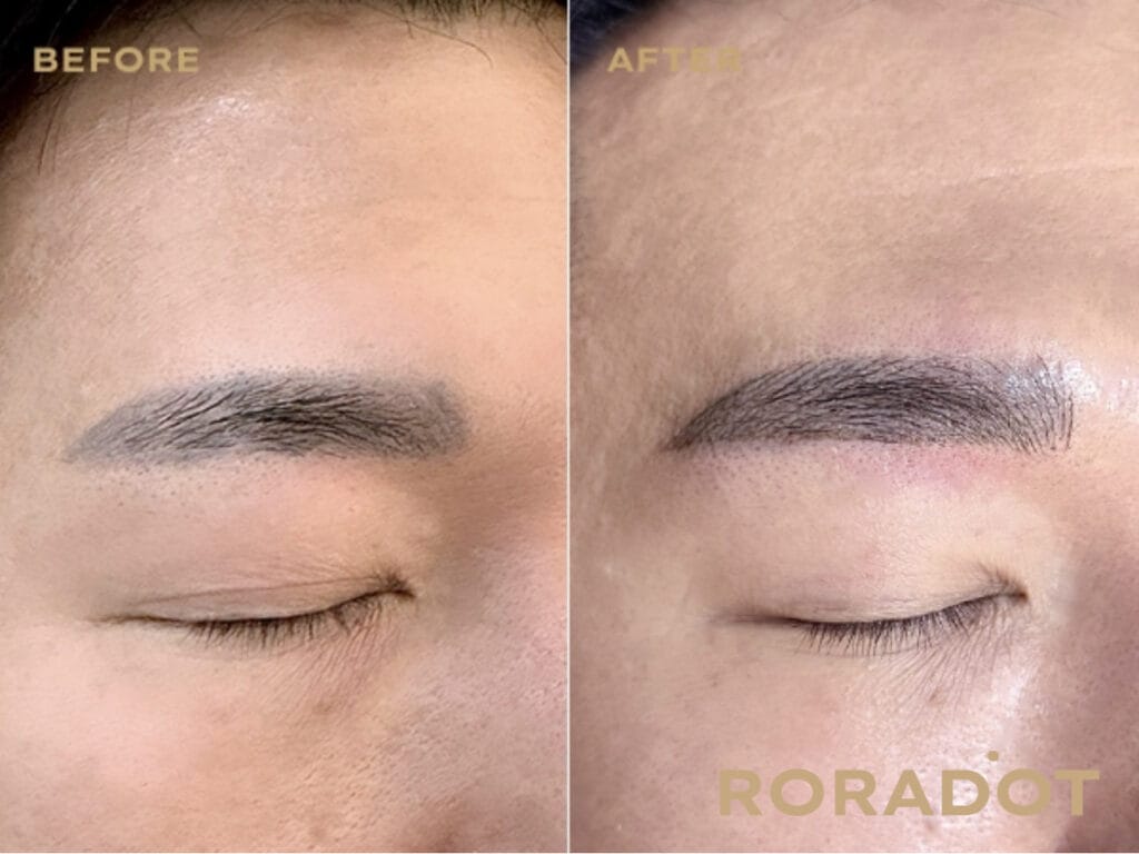 붉은눈썹문신 해결 방법 1가지? / 은평구,성북구,홍대 - 두피문신 교육 및 전문가 양성 | 로라도트 SMP 아카데미 남자 푸른 잔흔 눈썹 전 후