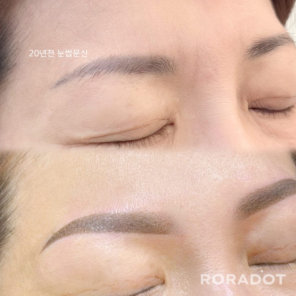 붉은눈썹문신 해결 방법 1가지? / 은평구,성북구,홍대 - 두피문신 교육 및 전문가 양성 | 로라도트 SMP 아카데미 푸른눈썹문신 전후