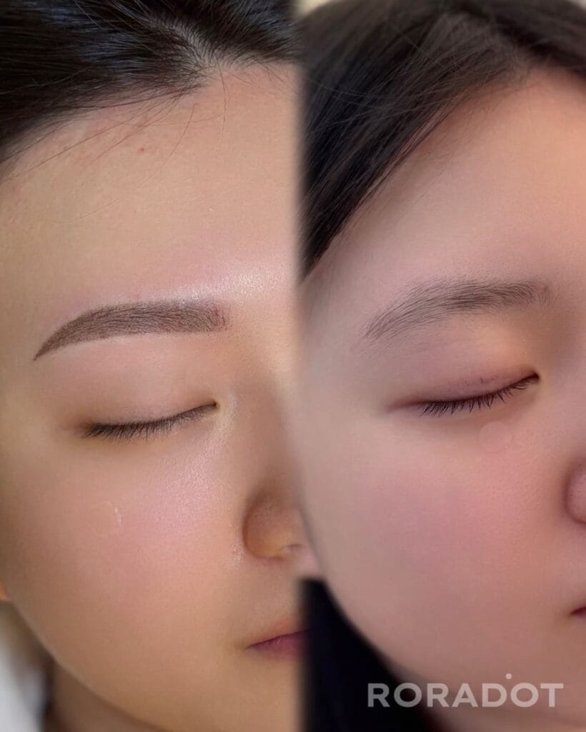 붉은눈썹잔흔, 시간이 지나면 해결될까요? 오히려 더 도드라집니다/은평구,성북구,홍대 - 두피문신 교육 및 전문가 양성 | 로라도트 SMP 아카데미