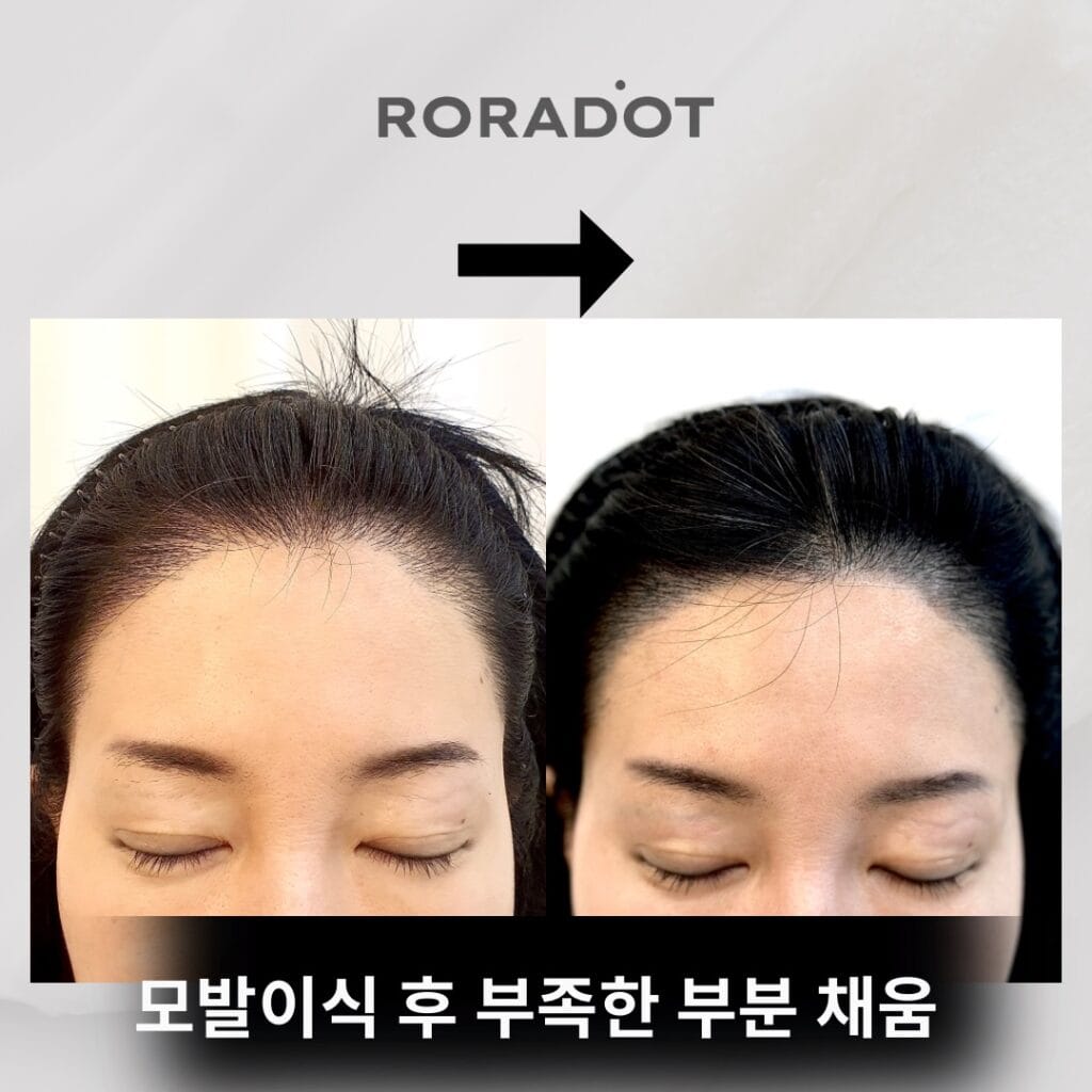 SMP 두피문신잘하는곳 - 두피문신 교육 및 전문가 양성 | 로라도트 SMP 아카데미 SMP헤어라인