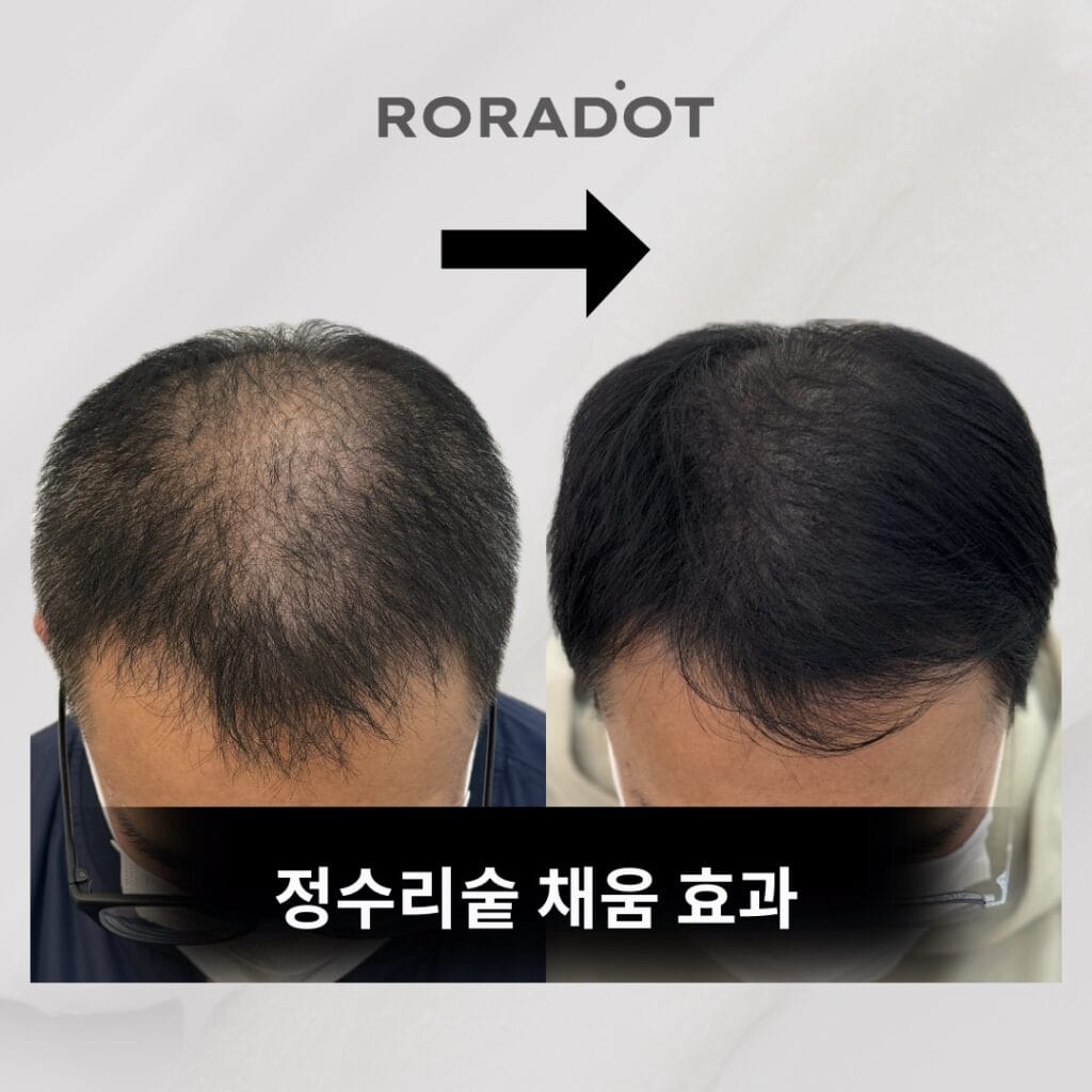 SMP 두피문신잘하는곳 - 두피문신 교육 및 전문가 양성 | 로라도트 SMP 아카데미 smp