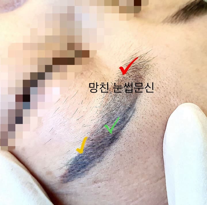 눈썹문신 제거