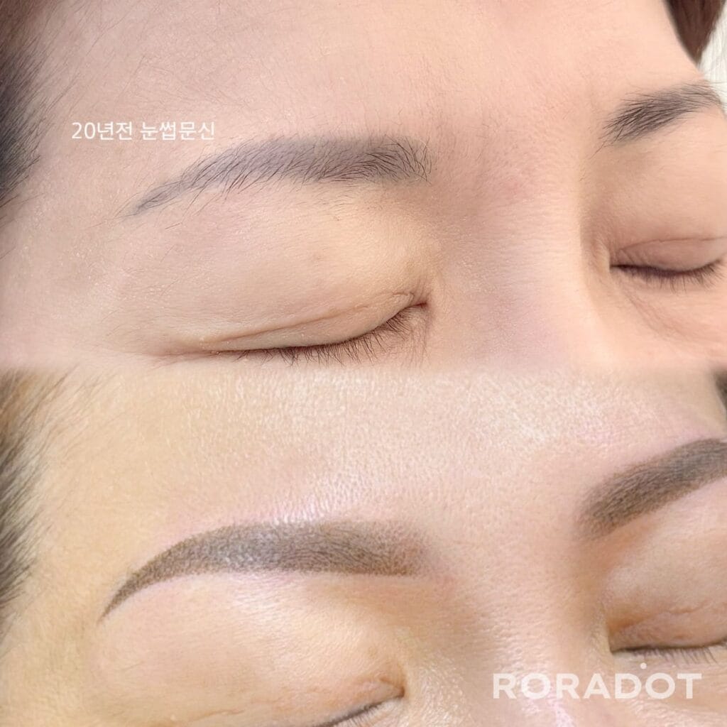 눈썹문신 제거