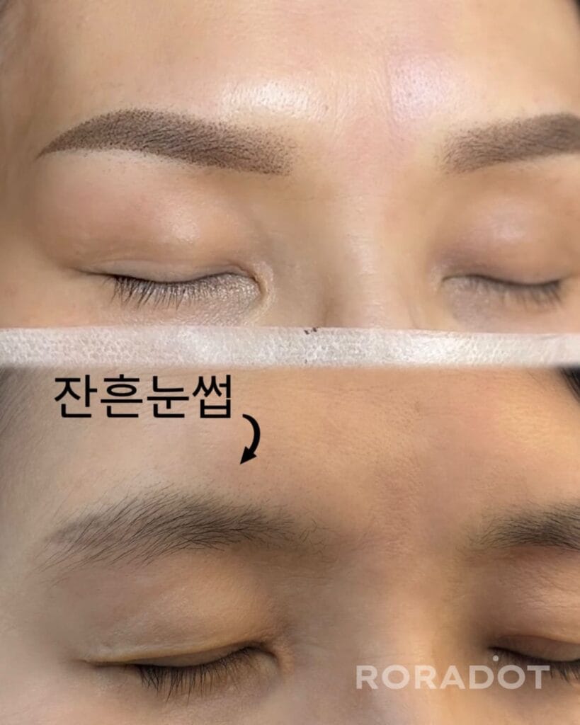 눈썹문신 레이저