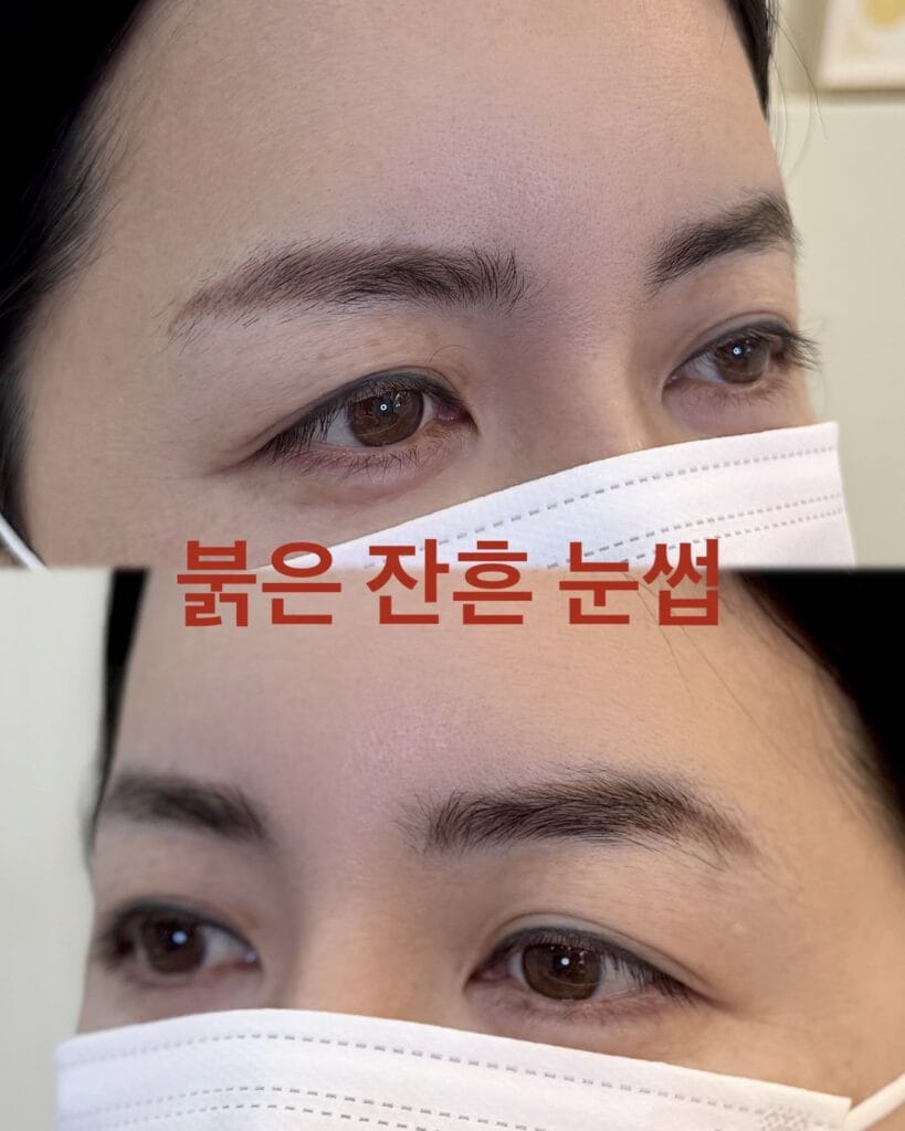 눈썹문신 제거 레이저 후 붉은기 복구방법 1가지 - 두피문신 교육 및 전문가 양성 | 로라도트 SMP 아카데미