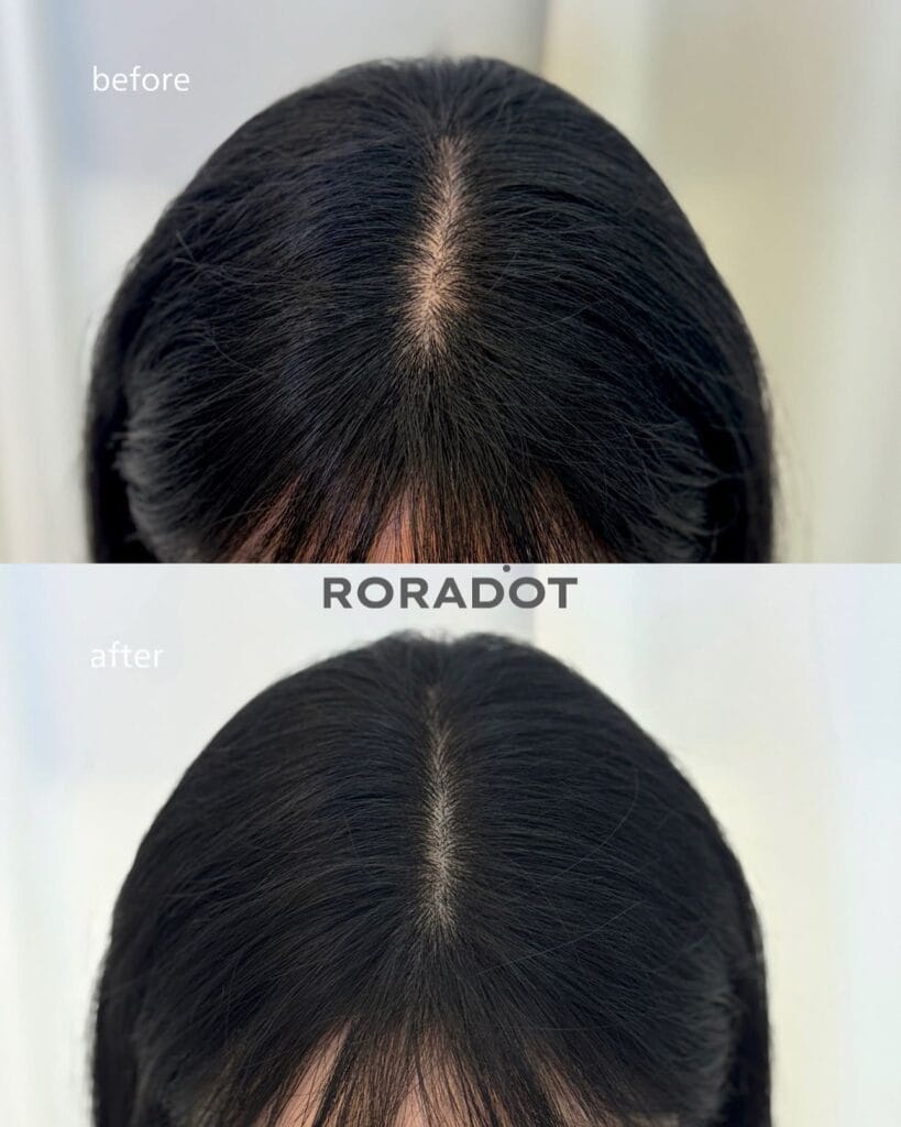 부산·인천 두피문신 배우기 | 가격보다 부작용 없는 기술이 먼저입니다 - 두피문신 교육 및 전문가 양성 | 로라도트 SMP 아카데미 두피문신 가격