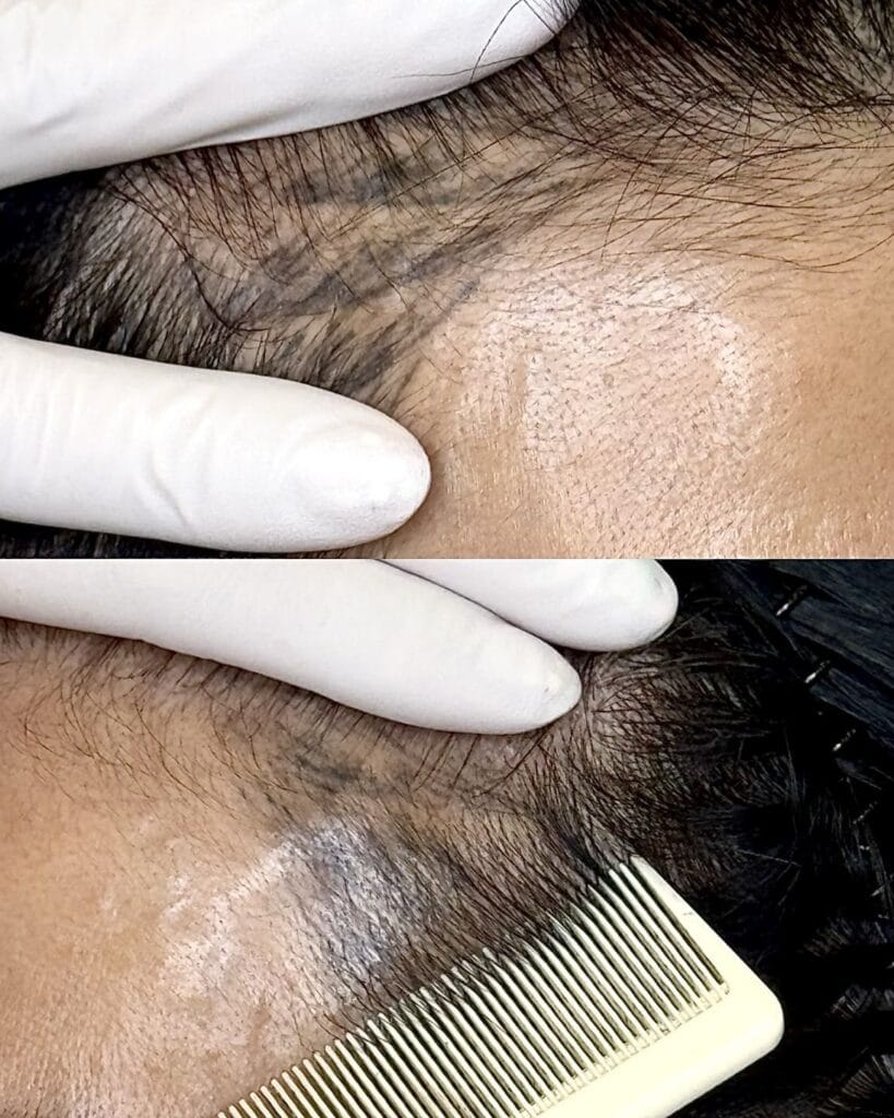 부산·인천 두피문신 배우기 | 가격보다 부작용 없는 기술이 먼저입니다 - 두피문신 교육 및 전문가 양성 | 로라도트 SMP 아카데미 두피문신 부작용