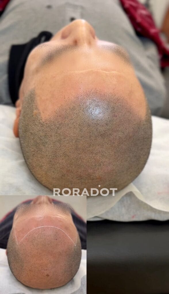 부산·인천 두피문신 배우기 | 가격보다 부작용 없는 기술이 먼저입니다 - 두피문신 교육 및 전문가 양성 | 로라도트 SMP 아카데미 두피문신