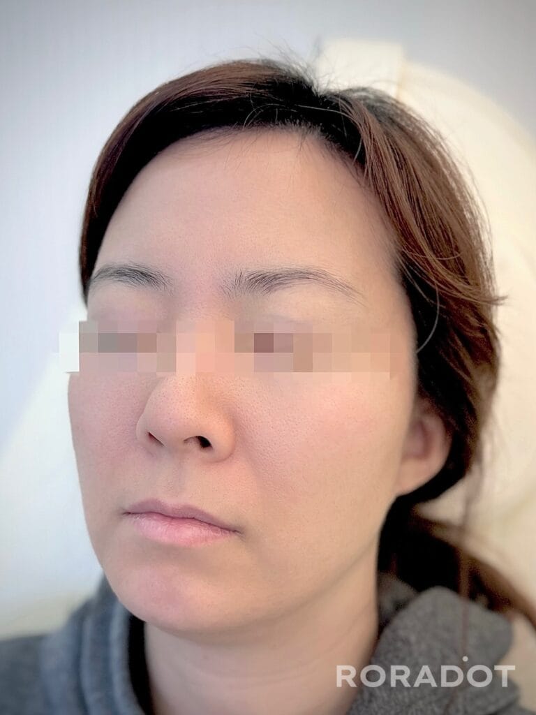 눈썹문신 제거 레이저 후 붉은기 복구방법 1가지 - 두피문신 교육 및 전문가 양성 | 로라도트 SMP 아카데미