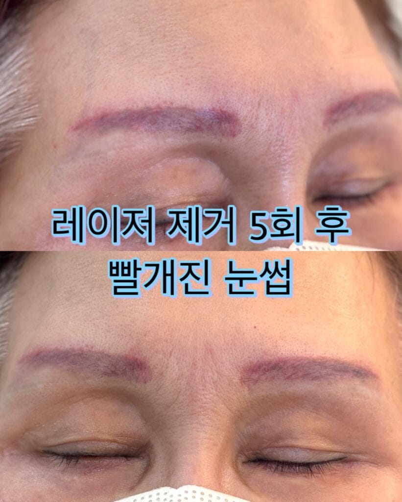 눈썹문신 제거