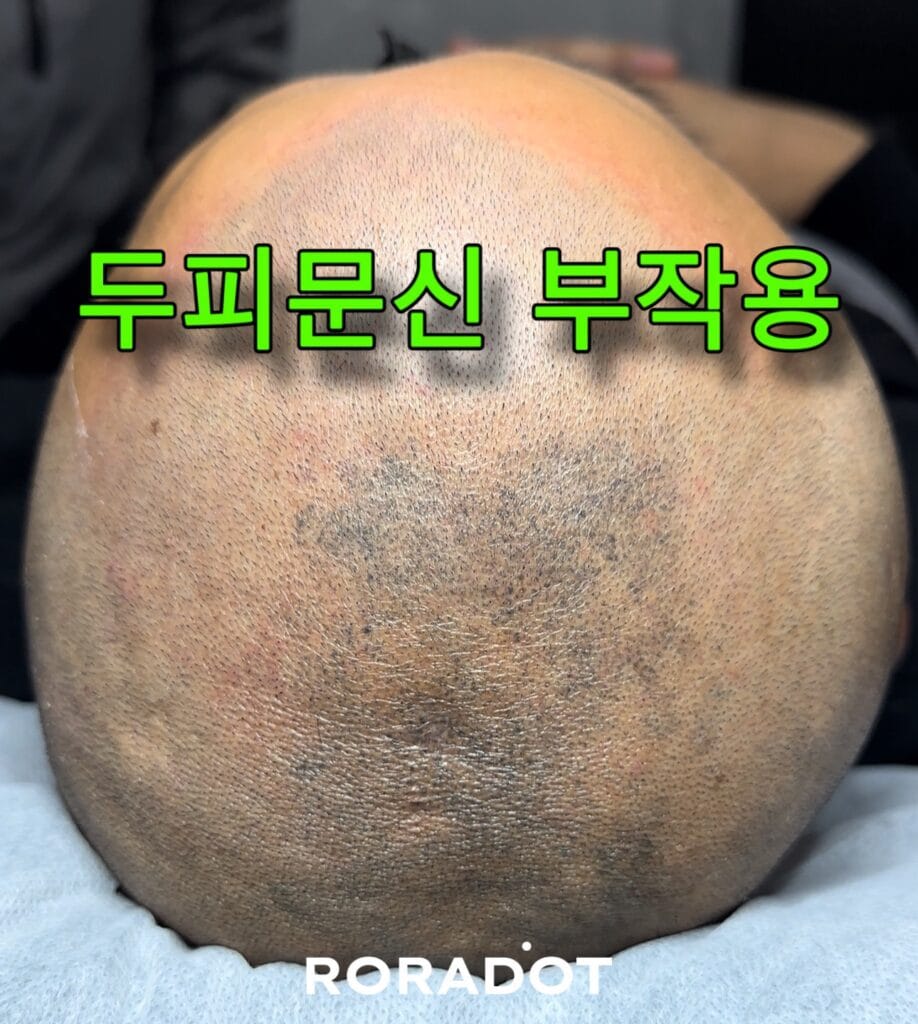 두피문신 부작용