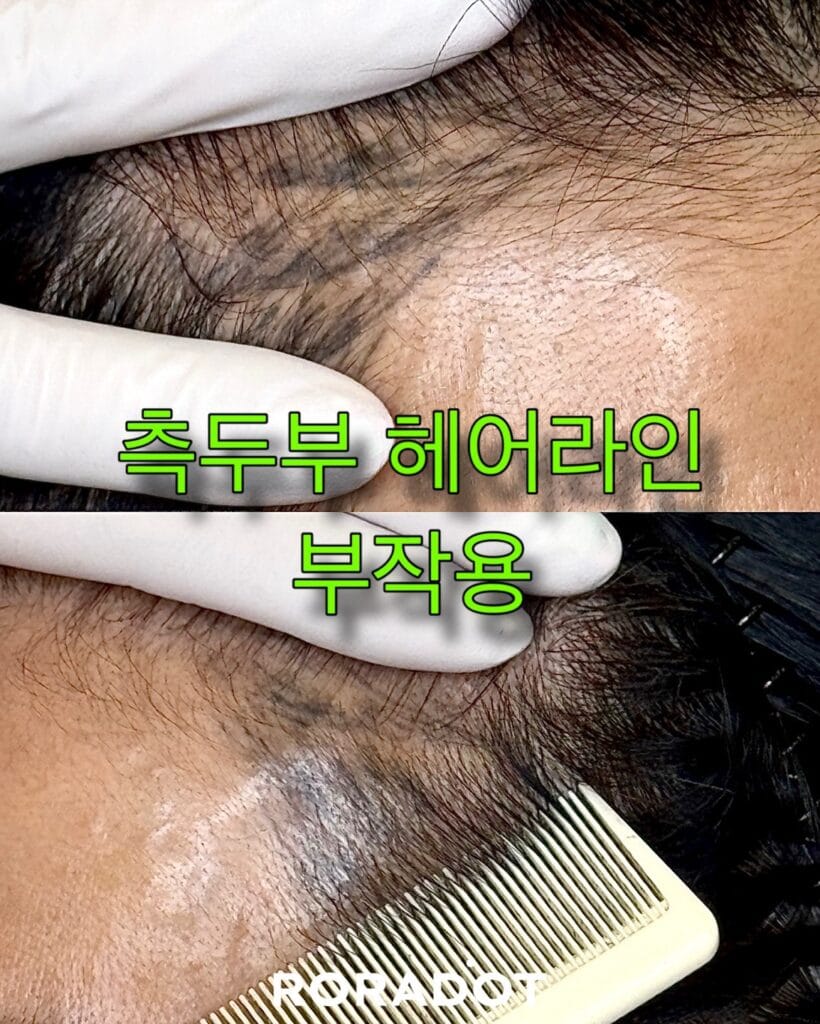 두피문신 부작용