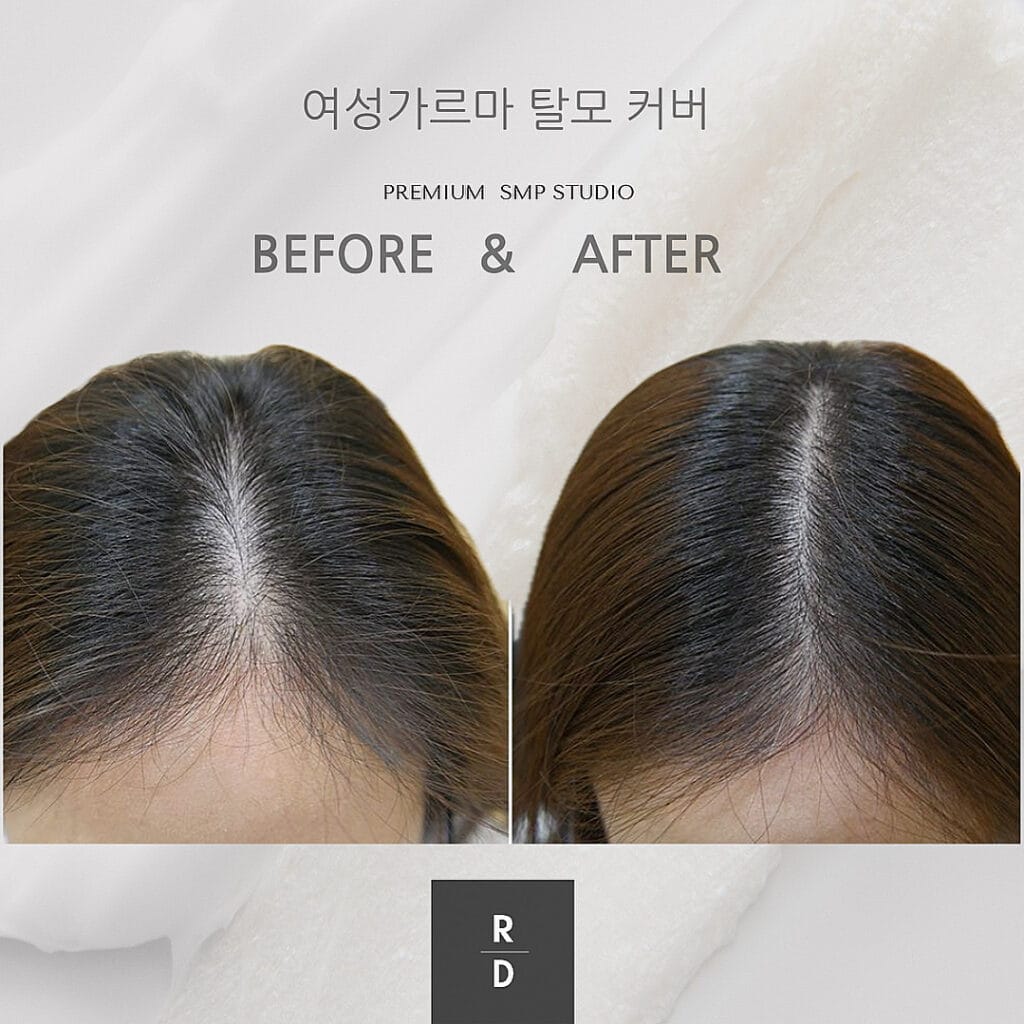 두피문신 유지기간, 5년 이상 유지하는 법 - 두피문신 교육 및 전문가 양성 | 로라도트 SMP 아카데미 두피문신