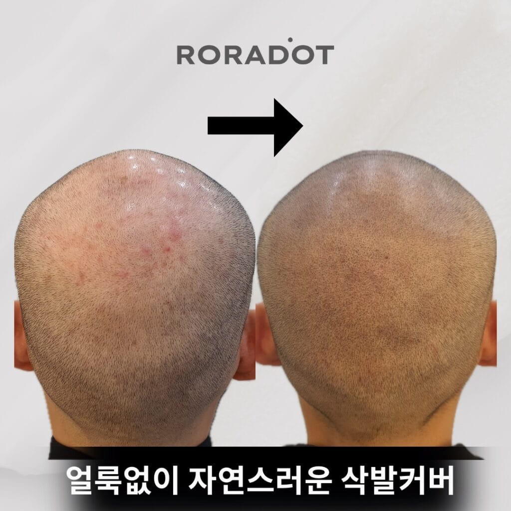 두피문신 유지기간, 5년 이상 유지하는 법 - 두피문신 교육 및 전문가 양성 | 로라도트 SMP 아카데미 두피문신 유지기간, 5년 이상 유지하는 법 - 두피문신 교육 및 전문가 양성 | 로라도트 SMP 아카데미