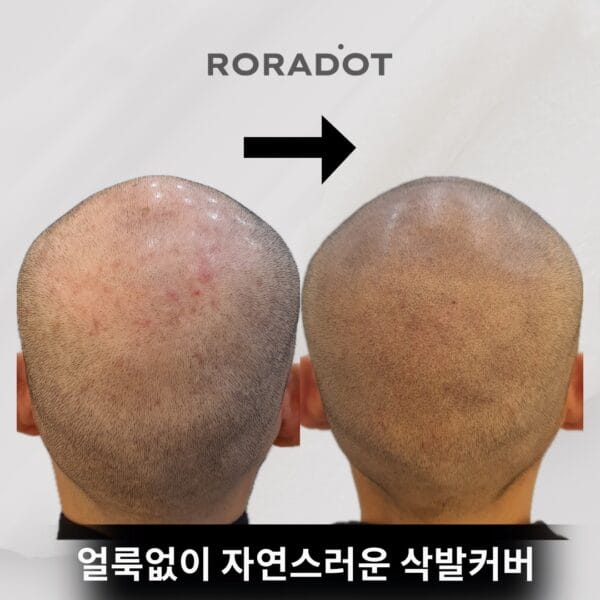 정통 방식 smp 전 과 후