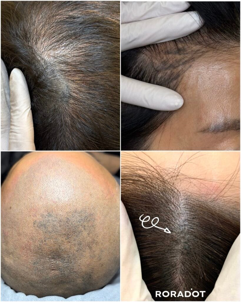 두피문신 유지기간, 5년 이상 유지하는 법 - 두피문신 교육 및 전문가 양성 | 로라도트 SMP 아카데미 두피문신 후 부작용