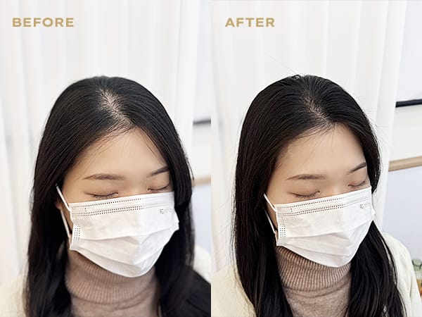 두피문신 유지기간, 5년 이상 유지하는 법 - 두피문신 교육 및 전문가 양성 | 로라도트 SMP 아카데미 두피문신 유지기간