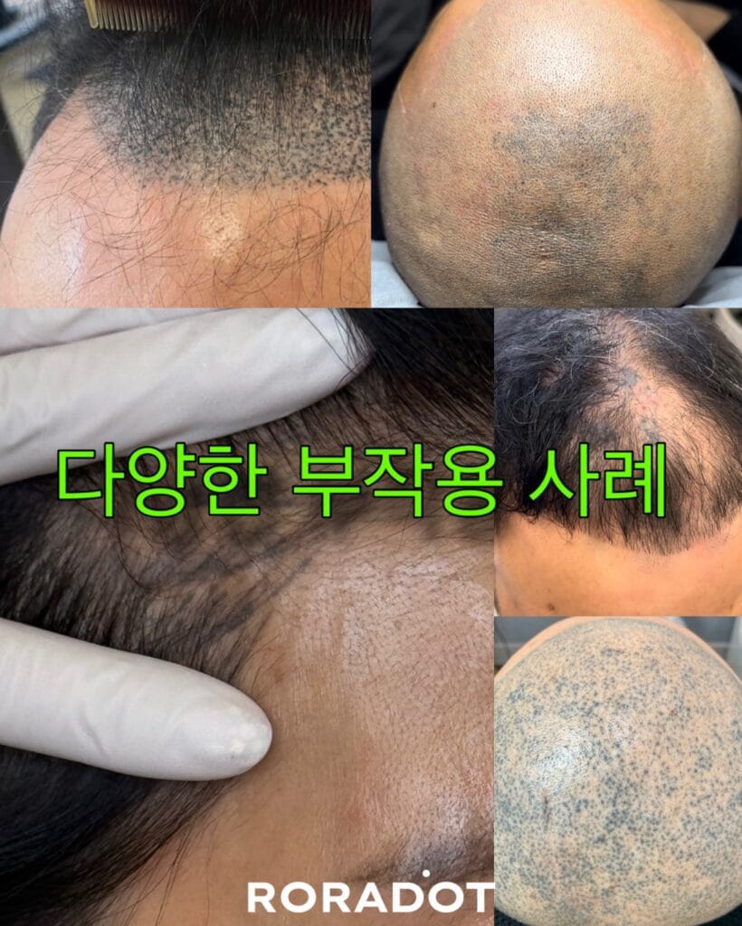 두피문신 교육 NO1, 기술만 배우는 수업으로는 부족합니다. - 두피문신 교육 및 전문가 양성 | 로라도트 SMP 아카데미 두피문신 교육 NO1, 기술만 배우는 수업으로는 부족합니다. - 두피문신 교육 및 전문가 양성 | 로라도트 SMP 아카데미