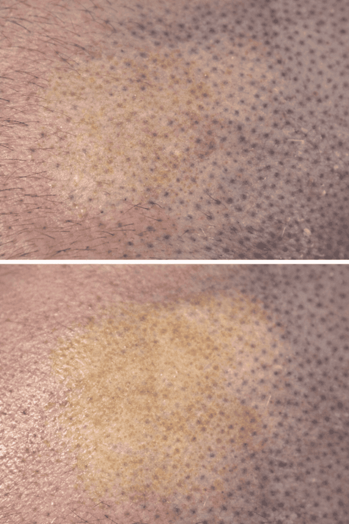 두피문신 부작용 7가지 원인과 예방법 – SMP 전문가가 말하는 구조적 리스크 - 두피문신 교육 및 전문가 양성 | 로라도트 SMP 아카데미 두피문신 부작용 7가지 원인과 예방법 – SMP 전문가가 말하는 구조적 리스크 - 두피문신 교육 및 전문가 양성 | 로라도트 SMP 아카데미