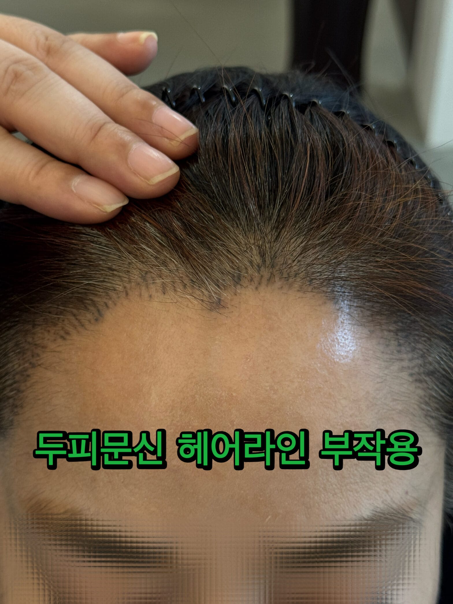 두피문신 부작용