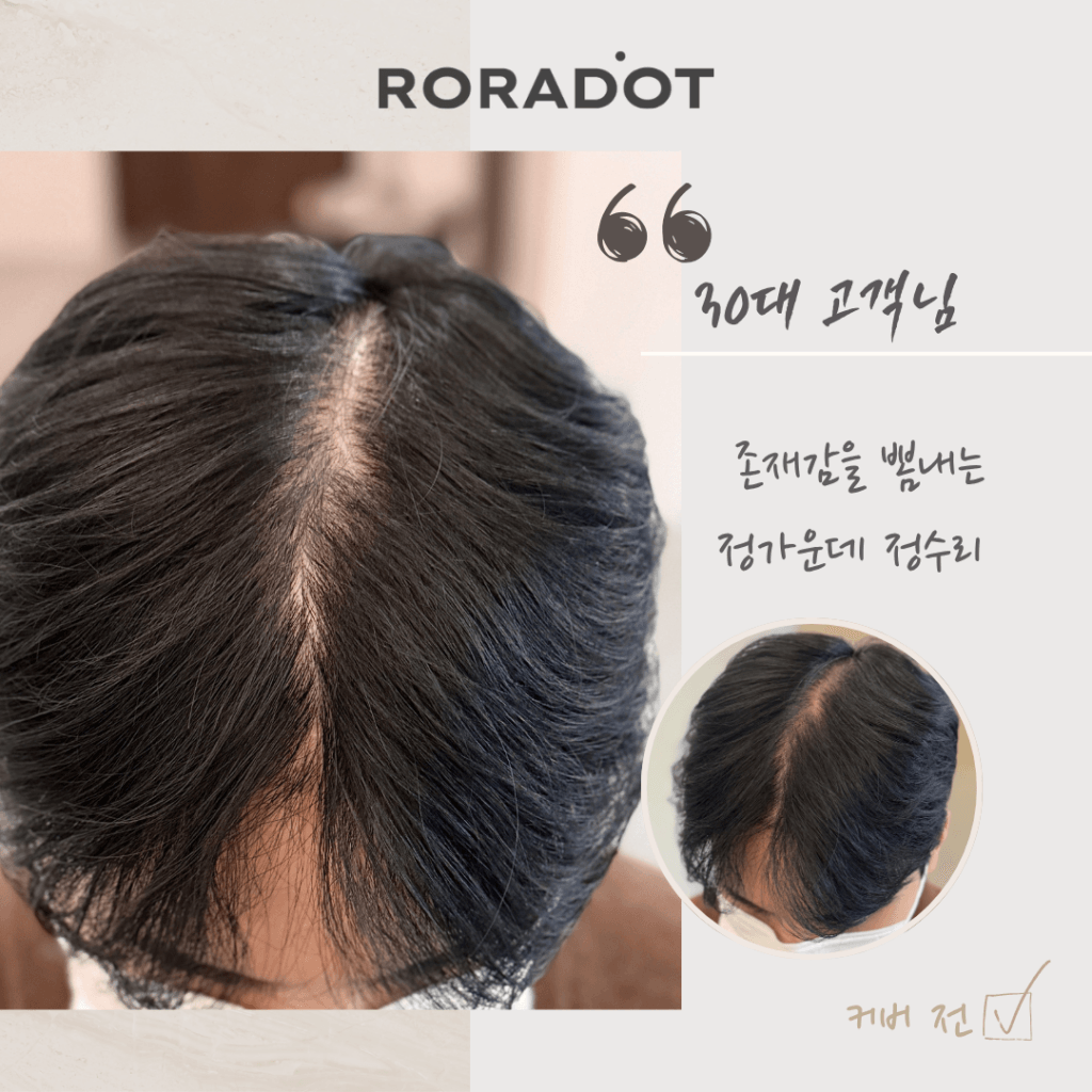 두피문신 부작용 5가지 원인, 왜 어떤 SMP는 몇 년 후 퍼질까? - 두피문신 교육 및 전문가 양성 | 로라도트 SMP 아카데미 두피문신 부작용 5가지 원인, 왜 어떤 SMP는 몇 년 후 퍼질까? - 두피문신 교육 및 전문가 양성 | 로라도트 SMP 아카데미
