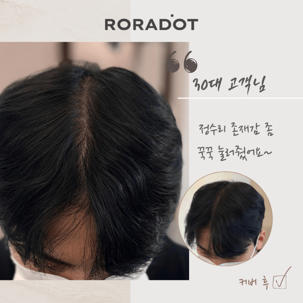 두피문신 부작용 5가지 원인, 왜 어떤 SMP는 몇 년 후 퍼질까? - 두피문신 교육 및 전문가 양성 | 로라도트 SMP 아카데미 두피문신 부작용 5가지 원인, 왜 어떤 SMP는 몇 년 후 퍼질까? - 두피문신 교육 및 전문가 양성 | 로라도트 SMP 아카데미